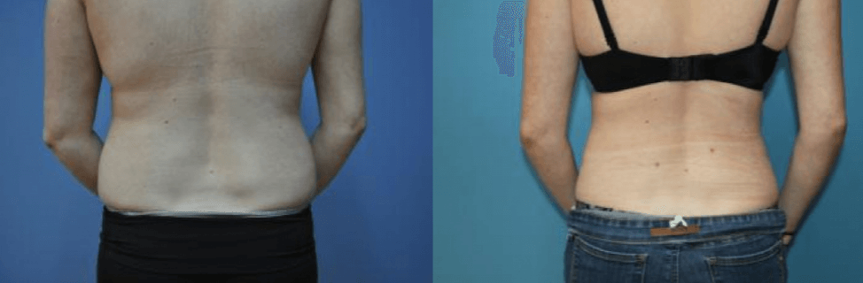 Love Handles And Flanks: Is There Any Difference?